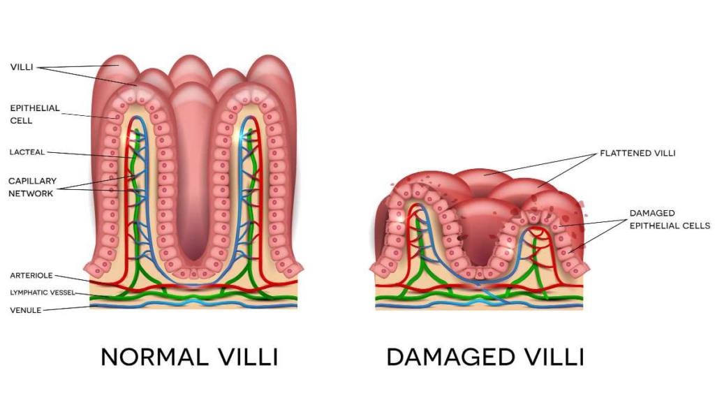 Celiac_damaged_villi