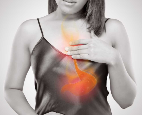 treating acid reflux